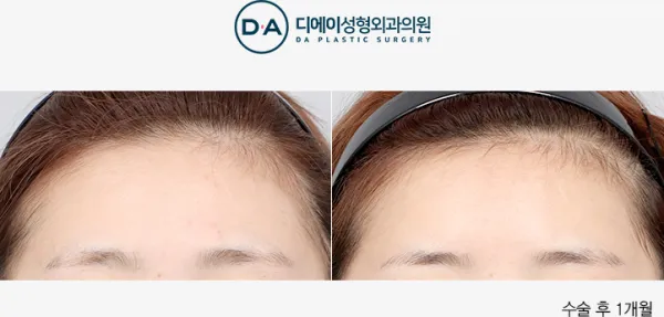 Before/After