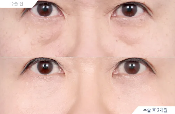 Before/After