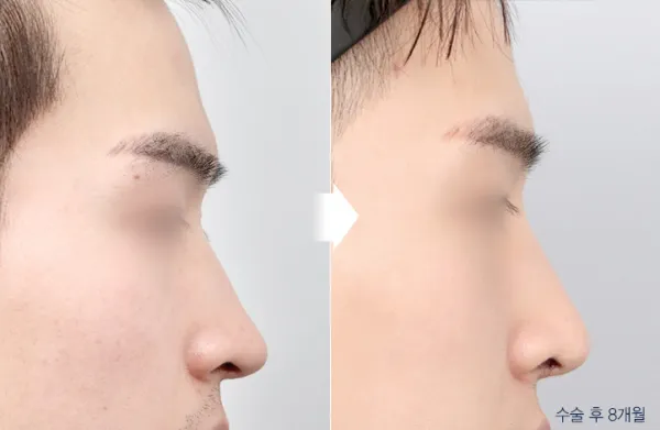 Before/After