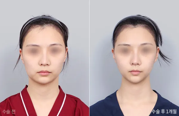Before/After