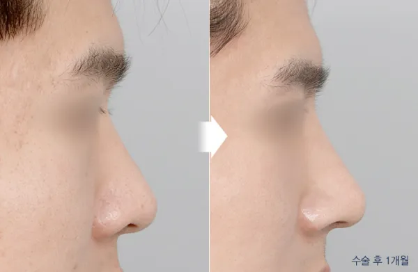 Before/After
