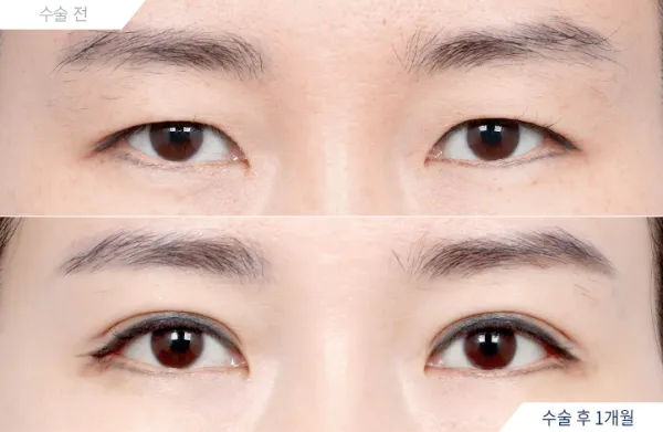 Before/After