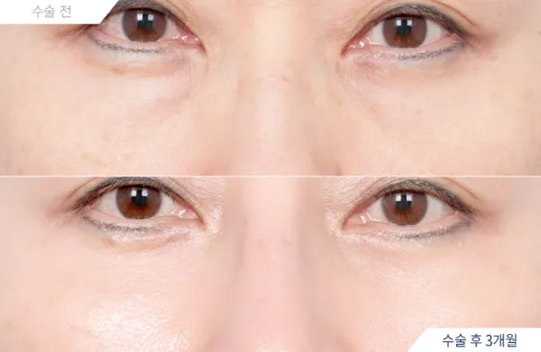 Before/After