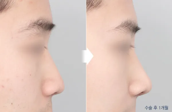 Before/After