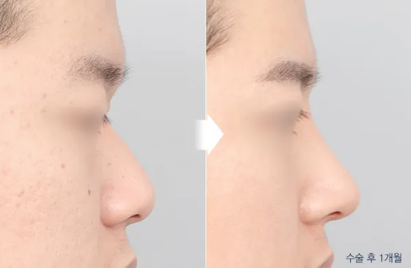 Before/After