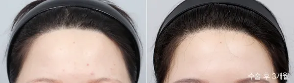 Before/After