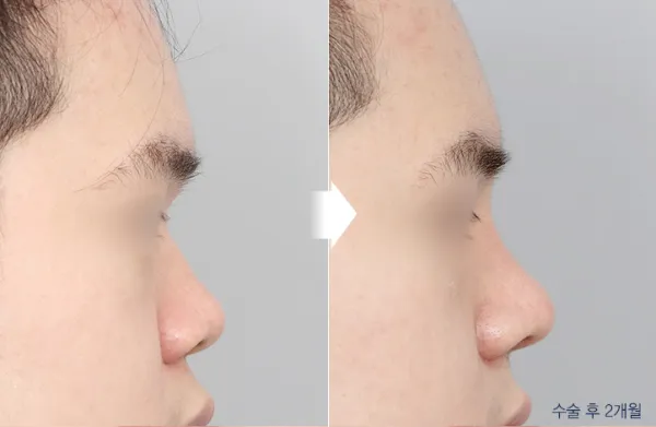 Before/After