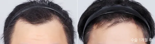 Before/After