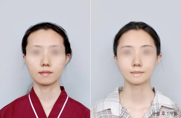 Before/After