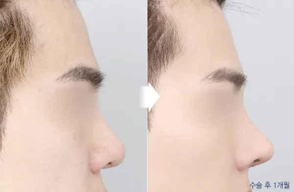 Before/After
