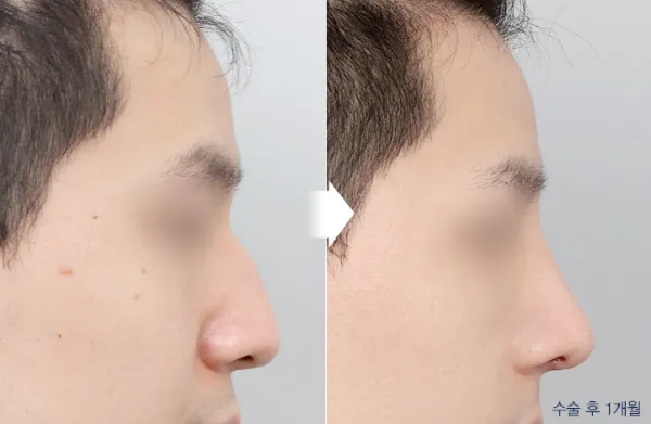 Before/After