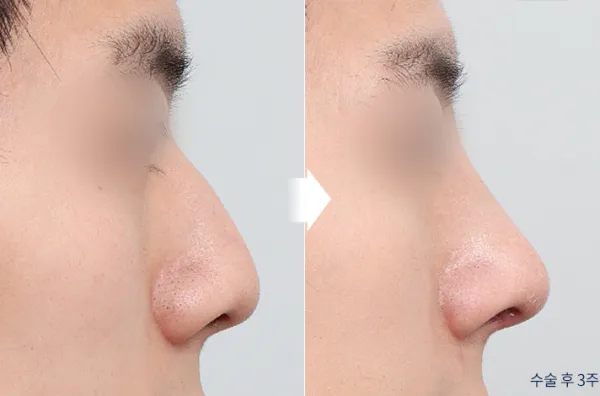 Before/After