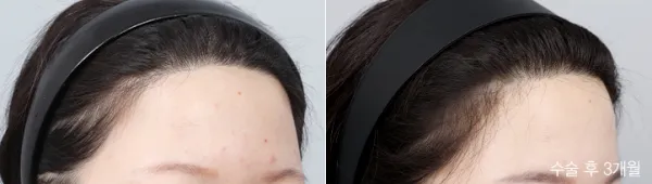 Before/After