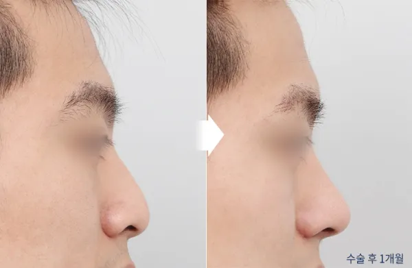 Before/After