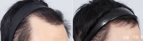 Before/After