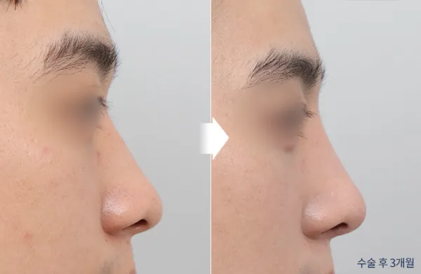 Before/After