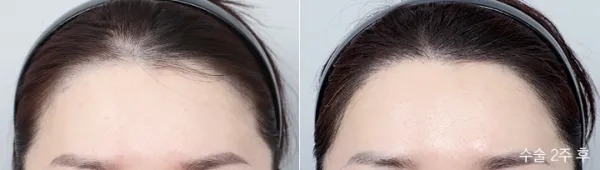Before/After
