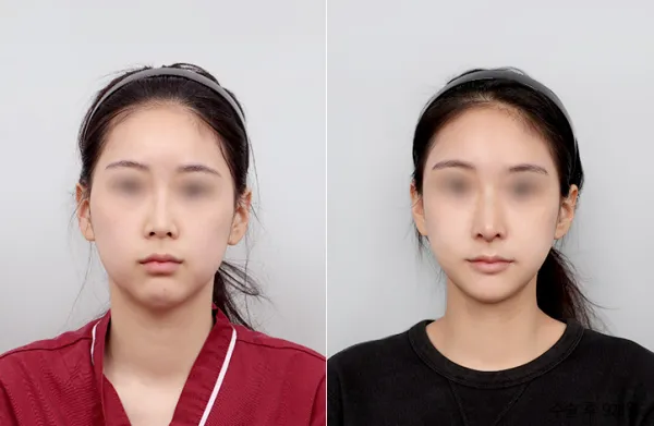 Before/After