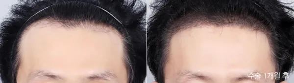 Before/After