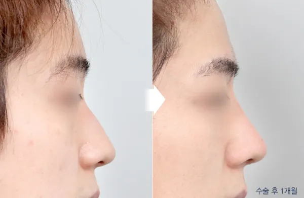 Before/After