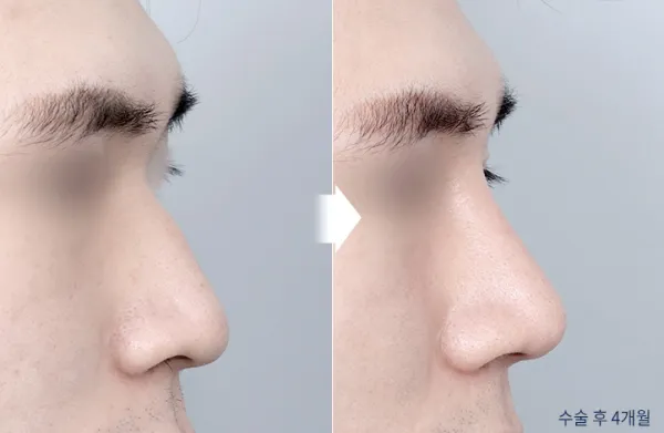 Before/After