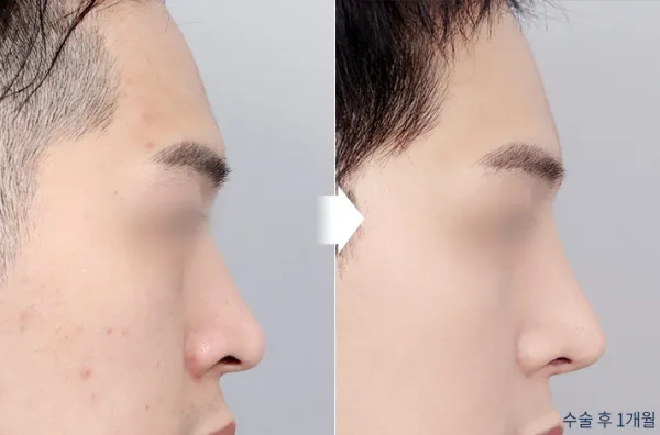 Before/After
