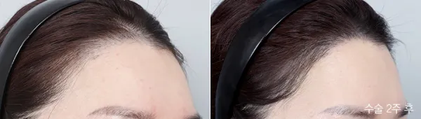 Before/After