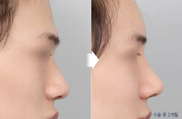Before/After