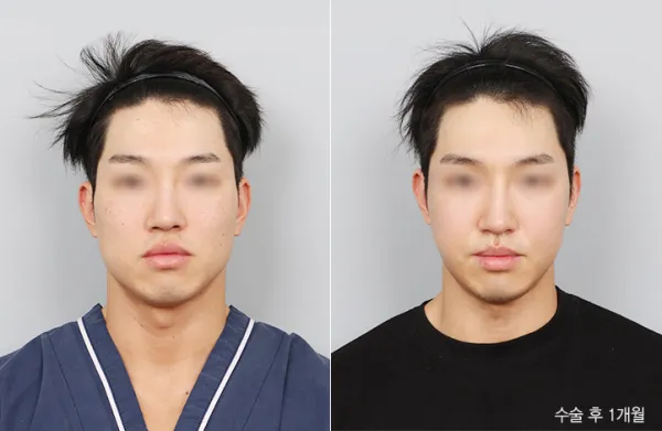 Before/After