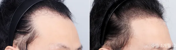 Before/After