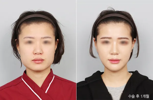 Before/After