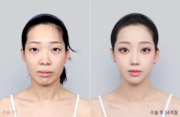 Before/After