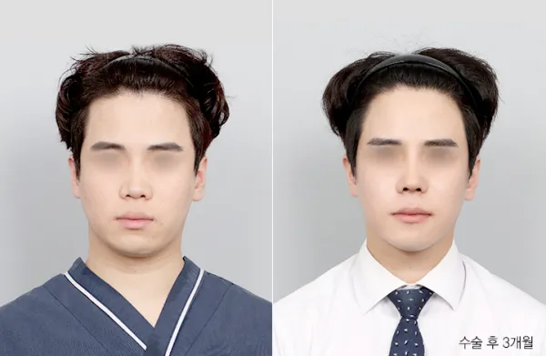 Before/After