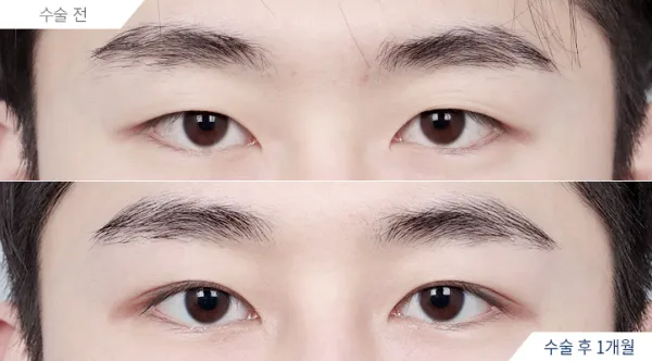 Before/After