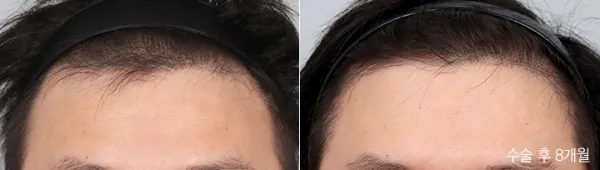 Before/After
