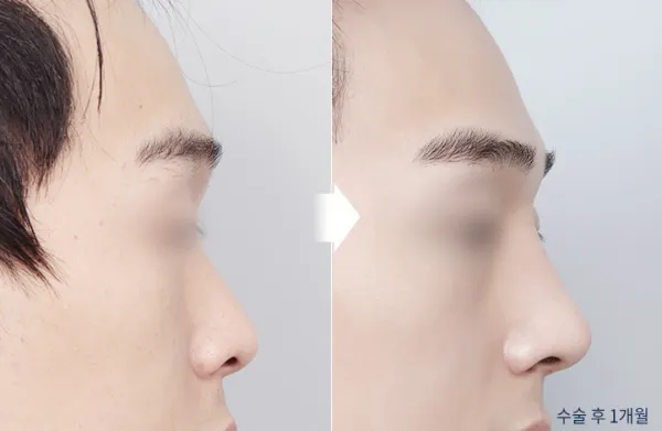 Before/After