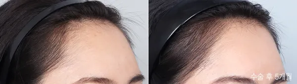Before/After