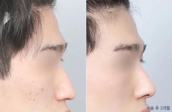Before/After