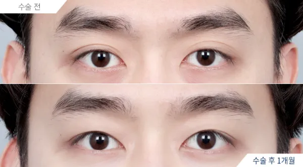 Before/After