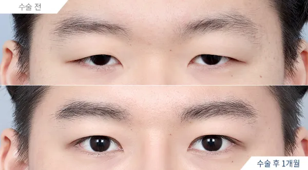 Before/After