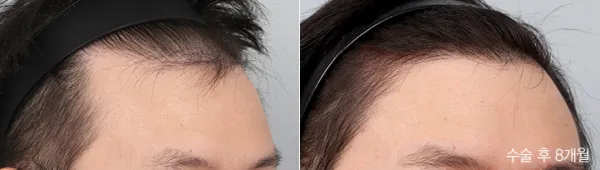 Before/After