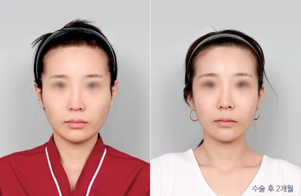 Before/After