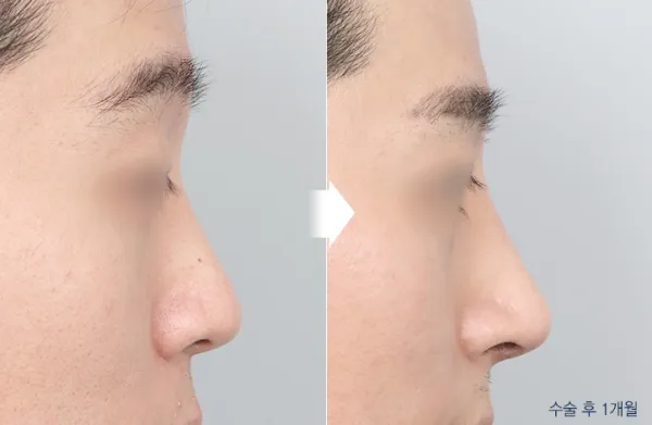 Before/After
