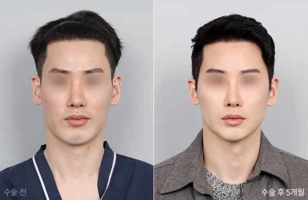 Before/After