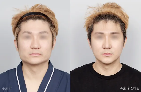 Before/After