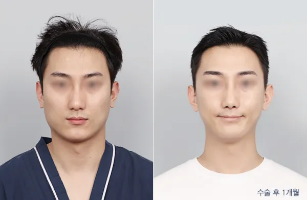 Before/After