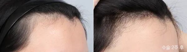 Before/After