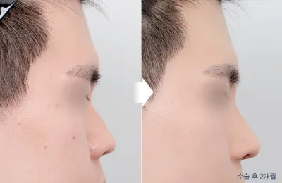 Before & After