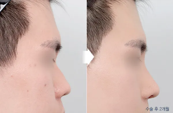 Before/After