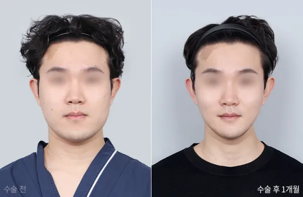 Before/After